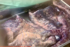 Smoker's Lungs. Stop vaping hypnosis, quit smoking hypnosis on long island
